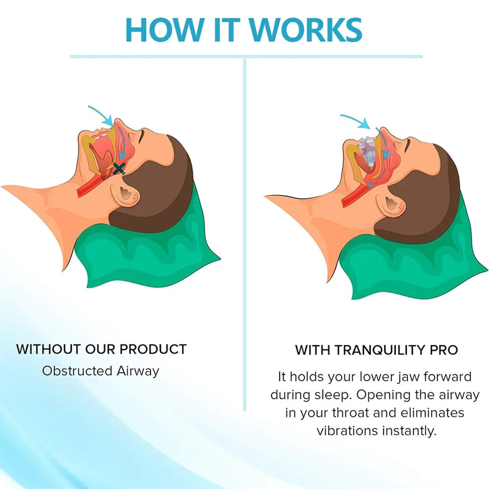 Anti Snoring Bruxism Mouth Guard Improve Sleeping Teeth Bruxism Sleeping Anti Snoring and Apnea Snoring Device To Stop Snoring