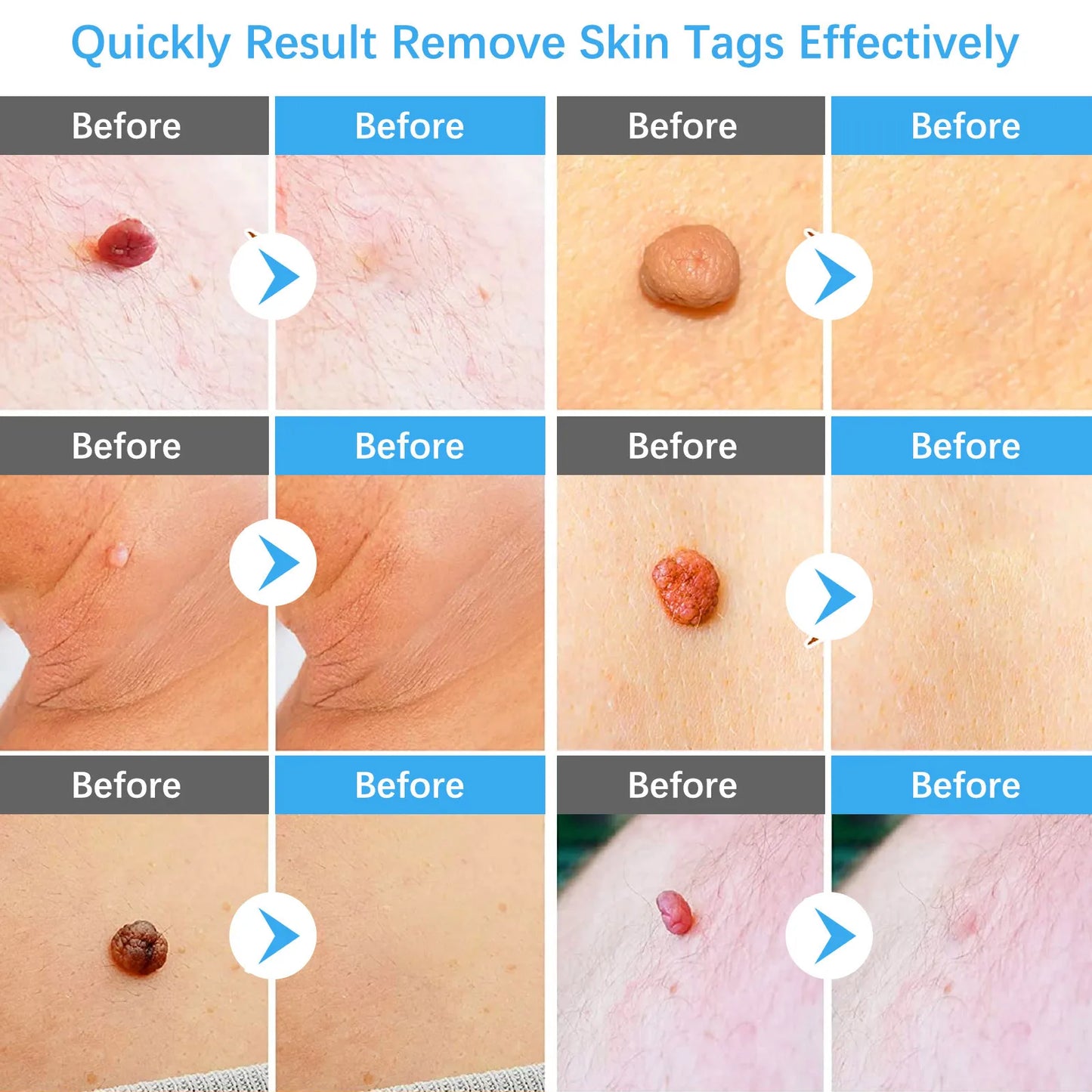 2-IN-1 Innovative Skin Tag Remover Kit Micro Skin Tag Removal Device Adult Mole Stain Wart Remover Face Care Beauty Tools