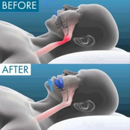 Anti Snoring Mouthpiece Reusable Snore Device Stopper Reduce Snoring Aid Snore Solution For Comfort Easy Breathing