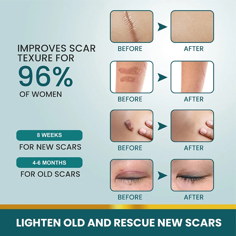 Z. 1 Roll Silicone Scar Sheets Gel Scar Patch 4cmX150cm Self-Adhesive Scar Cover Tape Reusable And Effective Skin Care Strips