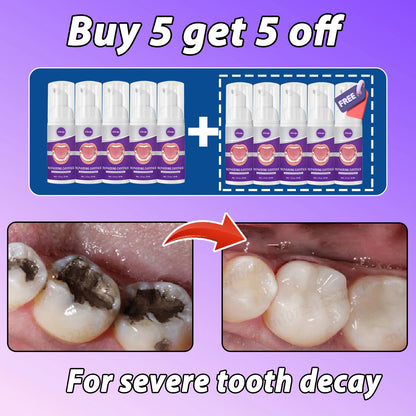 Tooth decay Repair Repairing Cavities Protecting Anti Caries