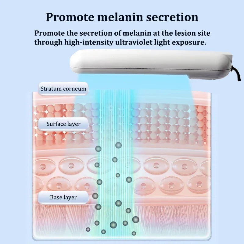 311NM UVB Phototherapy Lamp Device for Vitiligo Treatment UV NarrowBand Ultraviolet Light Therapy Psoriasis Spots Eczema