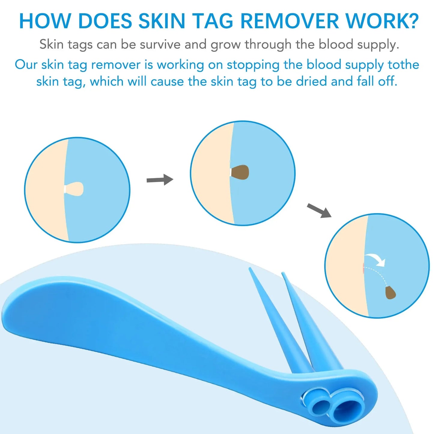 2-IN-1 Innovative Skin Tag Remover Kit Micro Skin Tag Removal Device Adult Mole Stain Wart Remover Face Care Beauty Tools