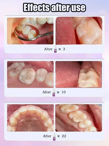 Effective Teeth Whitening Tooth decay repair  Calculus Plaque Periodontitis Remove Cavities