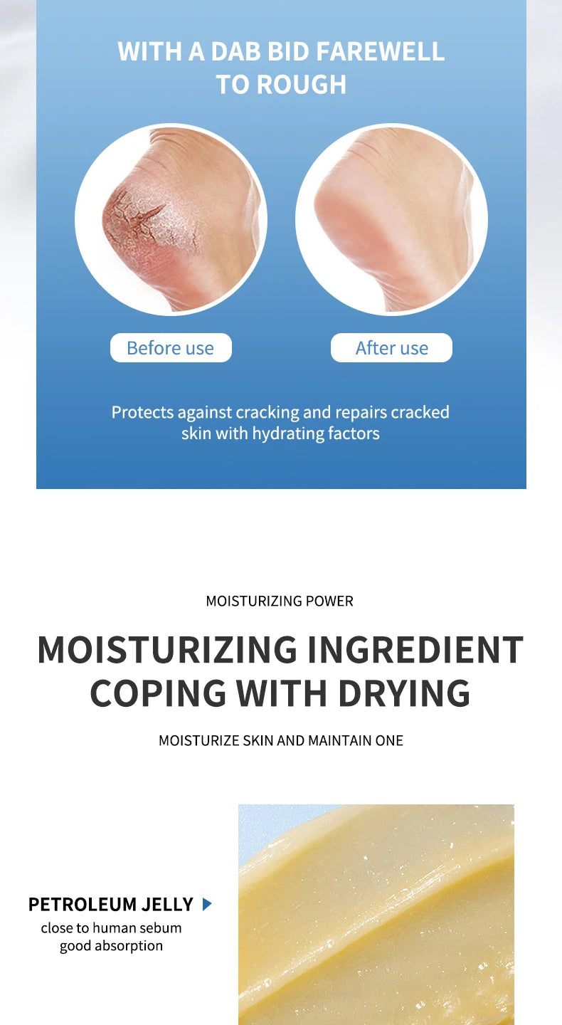 Anti Crack Foot Cream For Dry And Cracked Feet And Heels, Moisturizing Dry Feet And Heels, Preventing Your Feet From Cracking