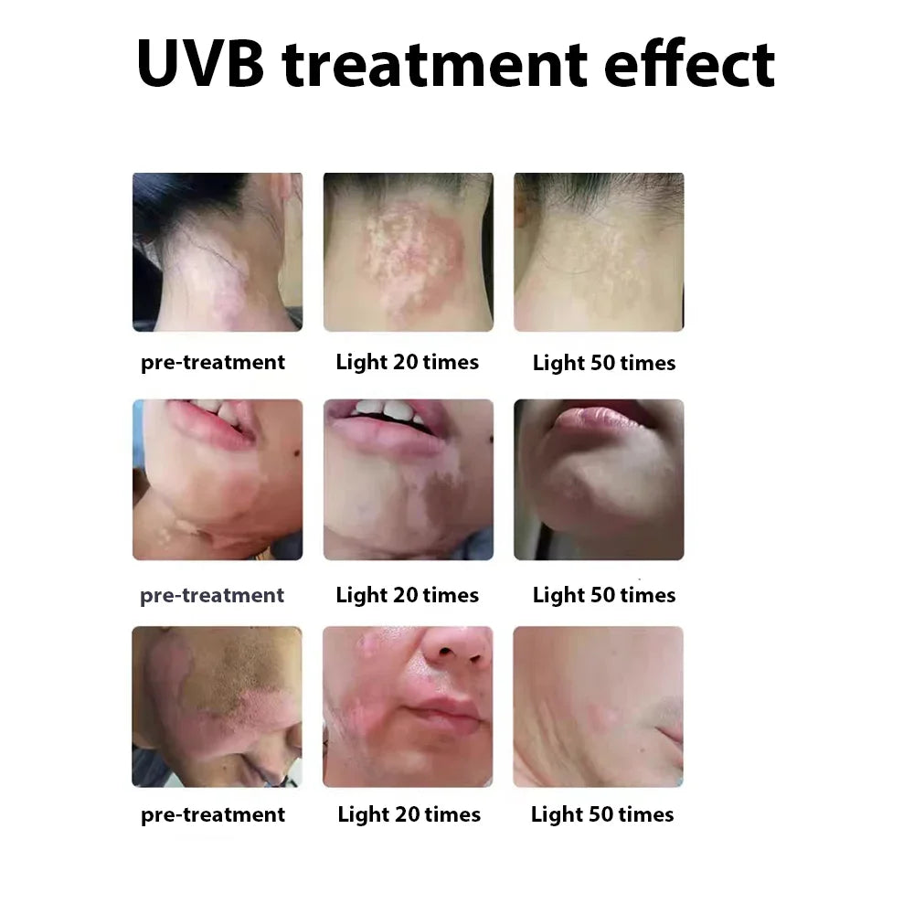 311nm Ultraviolet Phototherapy Instrument Double Lamp UVB Lamp for Vitiligo Treatment Psoriasis Lamp Skin Disease Device