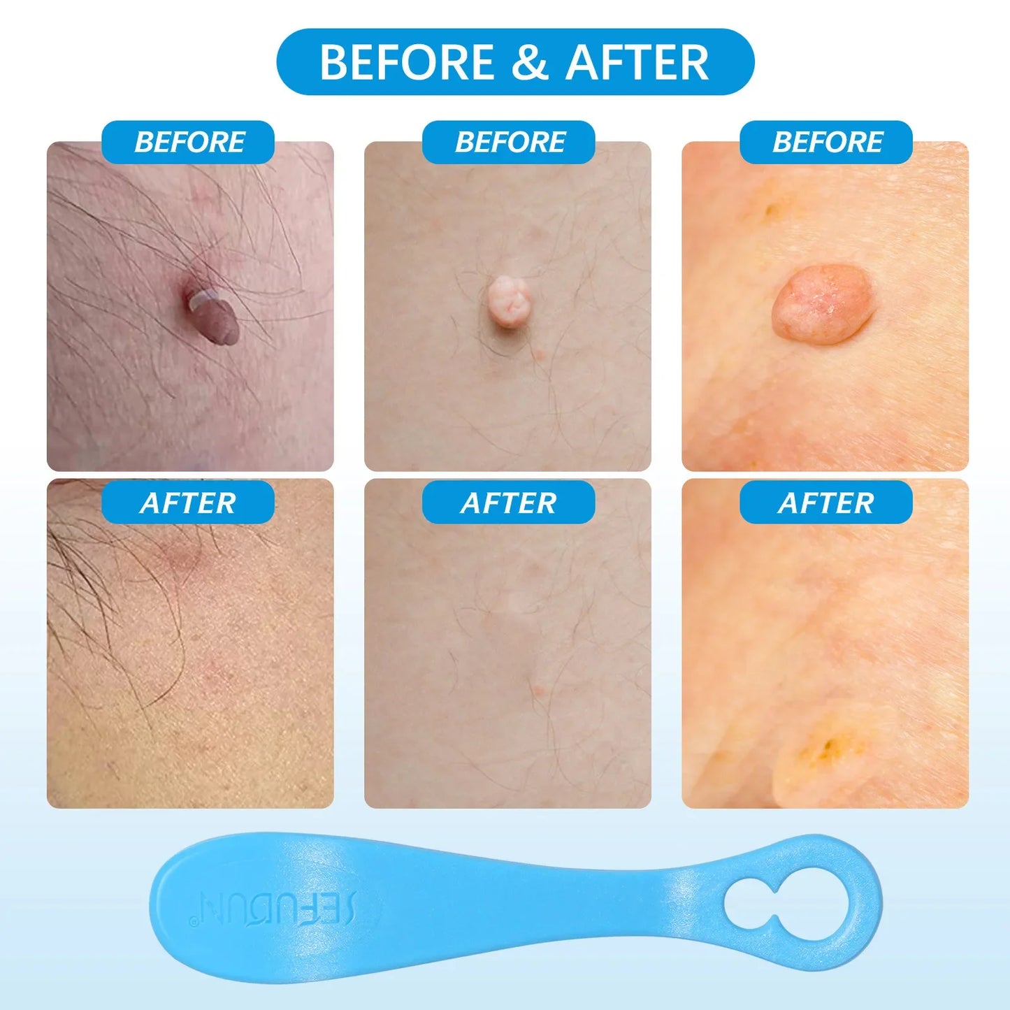 2-IN-1 Innovative Skin Tag Remover Kit Micro Skin Tag Removal Device Adult Mole Stain Wart Remover Face Care Beauty Tools