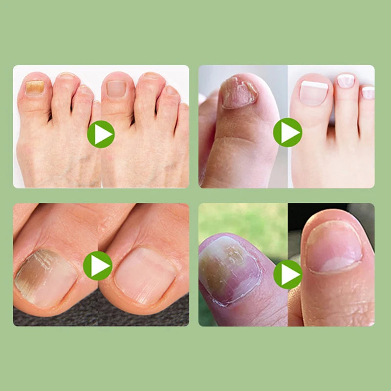 2/6/12Pc Ingrown Toenail Toe Correction Stickers Nail Art Foot Patches Feet Care Paronychia Treatment Recover Pedicure Foot Tool