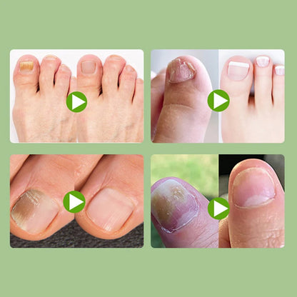 2/6/12Pc Ingrown Toenail Toe Correction Stickers Nail Art Foot Patches Feet Care Paronychia Treatment Recover Pedicure Foot Tool