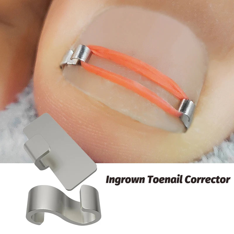 Toenail Correction Foot Care Tool Ingrown Toenail Corrector Tools Pedicure Recover Embed Toe Nail Treatment Professional