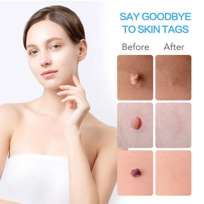 2-IN-1 Innovative Skin Tag Remover Kit Micro Skin Tag Removal Device Adult Mole Stain Wart Remover Face Care Beauty Tools