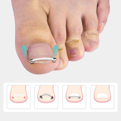 Ingrown Toenail Pedicure Tool Embed Toe Nail Care Straightening Correction Clip Curved Clamp Toenails Correction Tool For Toes