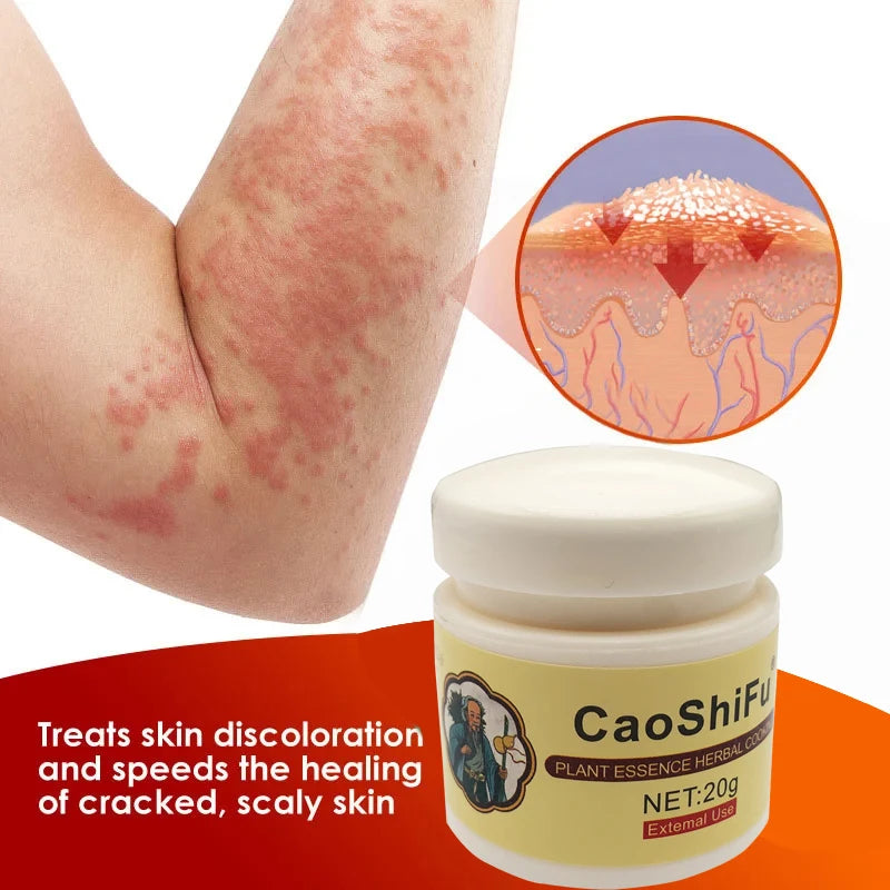 20g Psoriasis Cream Dermatitis Eczematoid Treatment Antibacterial Ointment Effective Body Anti-Itch Health Skin Care Products