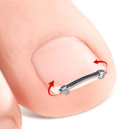 Ingrown Toenail Pedicure Tool Embed Toe Nail Care Straightening Correction Clip Curved Clamp Toenails Correction Tool For Toes