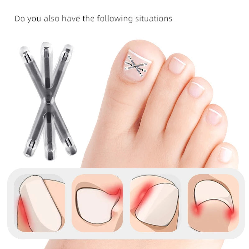 2Pc 13/17MM Ingrown Toenail Correction Tool Ingrown Toenail Treatments Elastic Patch Sticker Toenail Straightening Pedicure Tool